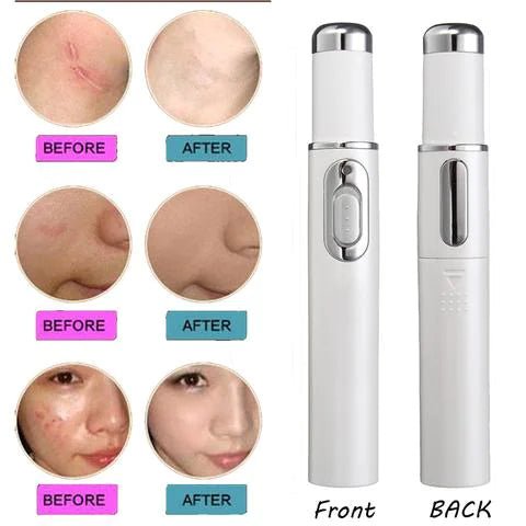 Blue Light Therapy Acne Laser Pen - Scar & Blemish Reduction - GNS Beauty & Personal Care