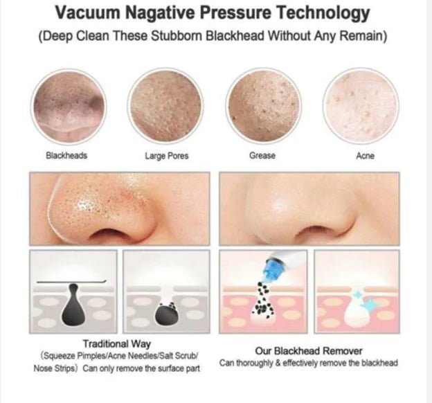 Electric Blackhead Remover Pore Vacuum - Deep Cleansing & Skin Rejuvenation - GNS Beauty & Personal Care